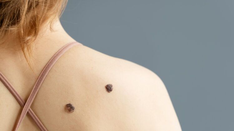 Skin Tags Caused: Common Causes, Risk Factors, Treatment & Prevention