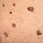Skin Tags Caused: Common Causes, Risk Factors, Treatment & Prevention