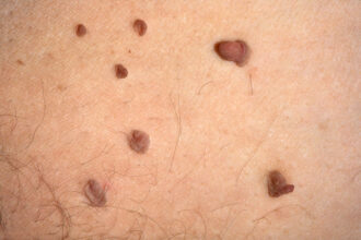 Skin Tags Caused: Common Causes, Risk Factors, Treatment & Prevention