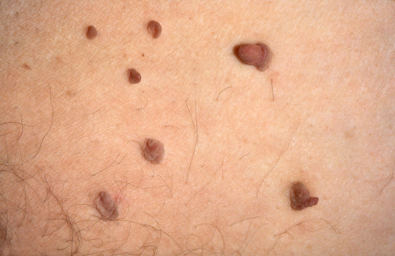 Skin Tags Caused: Common Causes, Risk Factors, Treatment & Prevention